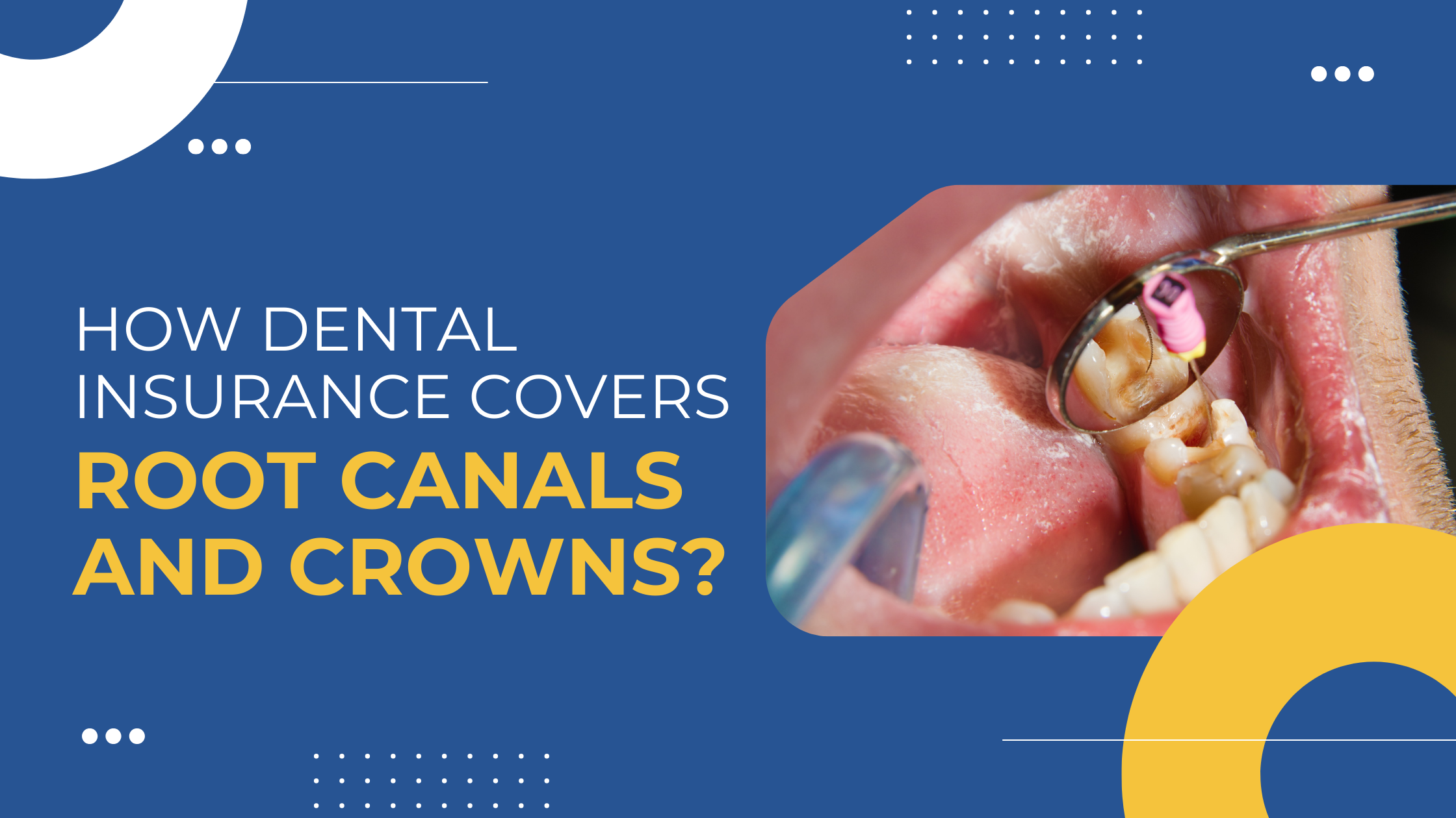 Read more about the article How Dental Insurance Covers Root Canals and Crowns