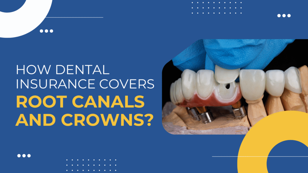 Dental Insurance Covers Root Canals